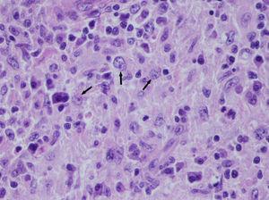 Histología de la pieza quirúrgica donde se observa efecto de emperipolesis, linfocitos incluidos en el citoplasma de macrófagos.