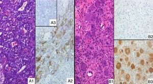 (A1) Adrenal medulla of the present case, without morphological abnormalities (H&E, ×20); (A2) positive ACTH immunostain of the same histological area as A1; (A3) absolute negative ACTH stain in an adrenal control case. (B1) Extra-adrenal ganglioneuroma (H&E, ×20); (B2) ACTH immunostain, absolutely negative; (B3) NSE positive expression in neuronal component, according to the diagnosis.
