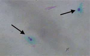 Micronúcleos (seta esquerda) e núcleo normal (seta direita) em células epiteliais esfoliadas orais (400×).