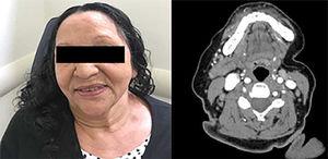 Ausência de lesões cervicais 72 meses após a hospitalização. A tomografia computadorizada manteve a resolução do tumor da glândula submandibular esquerda 75 meses após a remissão.