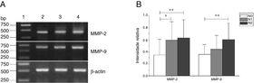 Expressão de mRNA de MMP‐2 e MMP‐9 em tecidos tumorais de diferentes estágios N obtidos de pacientes com carcinoma hipofaríngeo. (A) Expressão representativa de mRNA de MMP‐2 e MMP‐9 em tecidos tumorais de diferentes estágios N. A expressão de MMP‐2 e MMP‐9 aumentou com o aumento do estágio N (faixa 1, 1kb na escada de DNA; faixa 2, paciente estágio N0; faixa 3, paciente estágio N1; faixa 4, paciente estágio N2); (B) Intensidade relativa da expressão de mRNA de MMP‐2 e MMP‐9 em tecidos tumorais de diferentes estágios N. Os pacientes com metástase linfática exibiram níveis mais altos de expressão de mRNA de MMP‐2 e MMP‐9 do que os pacientes no estágio N0 (* p <0,05 e ** p <0,01).