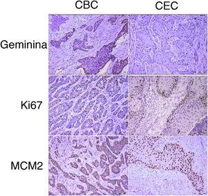 Seções representativas da imunoexpressão da geminina, ki67 e MCM2 no carcinoma espinocelular e carcinoma basocelular cutâneo de cabeça e pescoço (as barras de escala representam 0,1mm; a inserção na expressão de geminina do CBC mostra ampliação de 400×).