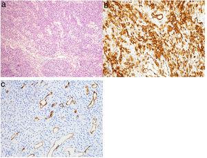 (a) Células tumorais fortemente compactadas com áreas sólidas e espirais e capilares em “chifre de veado” bem dispersos. (b) Coloração celular e citoplasmática difusa para betacatenina. (c) A coloração para CD34 destaca os vasos, mas é negativa para células tumorais.
