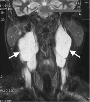 Imagem coronal de ressonância magnética ponderada em T2 mostra tumores hiperintensos bilaterais (setas brancas) no espaço parafaríngeo com realce heterogêneo pelo contraste.