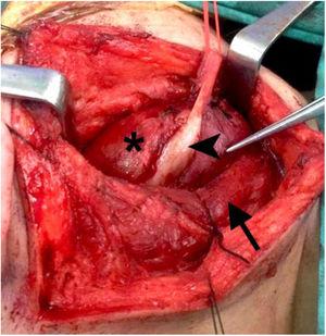 O tumor (*) localizado profundamente no músculo esternomastoideo (seta), ligado ao nervo hipoglosso (ponta de seta).
