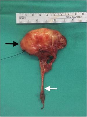 O tumor tinha envolvido toda a extremidade proximal do nervo hipoglosso (seta branca). A seta preta mostra a extremidade cranial do tumor.
