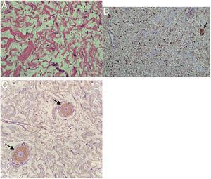 (A) As células tumorais exibem cromatina granular fina, núcleos bifurcados com contorno estreito e afilado, nucléolos imperceptíveis e citoplasma pálido mal definido (H&E, 100 ×). (B) Células fusiformes e células ganglionares maduras (seta) positivas para S100. (C) Células ganglionares maduras (seta) positivas para sinaptofisina.