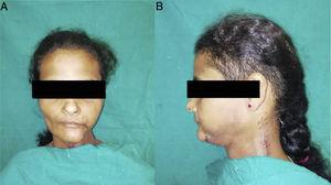 (a) Perfil anterior; (b) Perfil lateral de um caso submetido a cirurgia com um mês de pós‐operatório mostra mudança nominal no contorno facial.