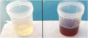A urina de cor normal da paciente ficou escura após a alcalinização com KOH.