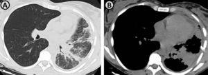 (A and B) Axial thoracic computed tomography images demonstrate the presence of a pulmonary mass in the left lower lobe, with perihilar localization, conditioning partial atelectasis of this lobe. There is also seen interlobular septal thickening, suggestive of lymphangitic carcinomatosis.