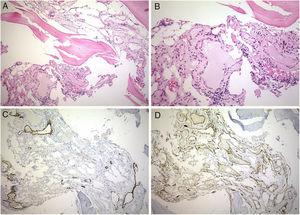 Bone biopsy. Gorham disease composed of numerous vascular spaces lined by attenuated endothelium. (A) Hematoxylin–eosin (10×). (B) Hematoxylin–eosin (20×). (C) Immunohistochemistry stain for D2-40 in endothelial cell of lymphatic vessels (10×). (D) Immunohistochemistry stain for CD31 in endothelial cells of capillary vessels (10×).