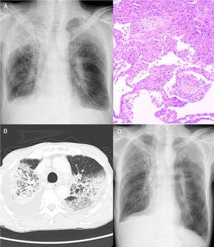 (A) Chest radiography and (B) computed tomography examination showed ground-glass opacity and consolidation in bilateral lung fields, as well as bilateral pleural effusion. (C) Haematoxylin and eosin staining of the lung biopsy specimen. Round-shaped fibroblasts (Masson bodies) were observed in the alveolar space; therefore, a pathological diagnosis of organizing pneumonia was made. (D) After two weeks of corticosteroid administration, chest radiography revealed improvement of ground-glass opacity and bilateral consolidation of the lungs.
