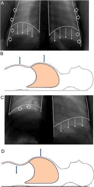 (A) Normal contraction of the diaphragm during quiet inspiration: the muscular action causes the diaphragm to move together like a piston in the caudal direction (direction of the arrows), thereby increasing abdominal pressure and decreasing pleural pressure. The latter is transmitted to the lung, causing it to be insufflated. (B) In supine position, it can be seen that both the rib cage and the abdomen move outwards. (C) When there is paralysis of the diaphragm (right side), the negative intrathoracic pressure drags the diaphragm and the abdominal viscera towards the thorax (direction of the arrows), which generates a negative abdominal pressure. (D) In supine position, it is observed how this negative abdominal pressure causes a paradoxical movement during inspiration: the abdomen moves inwards.