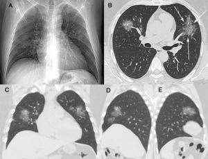 (A) A posteroanterior chest radiograph was considered normal. Unenhanced chest computed tomography with axial (B), coronal (C) and sagittal (D and E) maximum-intensity projection imaging demonstrated areas of ground glass opacity, many with round and oval morphologies, in both lungs. Not also in B inter- and intralobular septal thickening with a crazy-paving pattern (arrows).