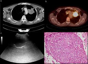 a) An approximately 5 × 5-cm mass in the left lung in thoracic CT. b) Homogeneous FDG uptake of the mass in PET-CT. c) Ultrasonographic image of the mass. d) Malignant tissue fragment (HEx400) whose structural and cellular details can be evaluated in the histopathologic preparation.