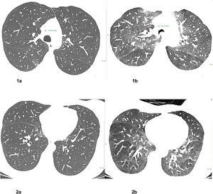 Lipid laden macrophages, Oil Red O staining. Chest CT 1 week after treatment onset: Corresponding axial CT images in inspiration (left row, Fig. 1a and 2a) and forced expiration (right row Fig. 1b and 2b) at 2 levels show small residual pulmonary ground-glass opacities (yellow arrows) in the medio basal right upper lobe and posterior right upper lobe, bronchial wall thickening, significant dynamic airways collapse (measurements of tracheal caliber, green) and mosaic attenuation with hypodense air trapping (images on the left).