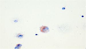 Lipid-laden macrophages in bronchoalveolar lavage fluid. Oil Red O staining.