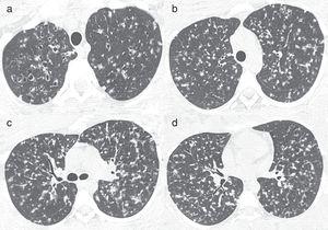 Axial CT images obtained 9 months before those presented in Fig.1 show diffuse multiple small nodules, some of which are cavitated, in the upper lobes.