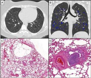Chest HRCT scans (A and B) and histopathological findings (C and D) of a 38-year-old woman with chronic cellular bronchiolitis and diffuse cystic lung disease. (A) Axial CT image shows diffuse, regular, and thin-walled pulmonary cysts. The quantification of cystic lung lesions is depicted in blue (B). The percentage of the total lung area occupied with cysts is 2.75%. The photomicrographies (C and D) show mild inflammatory mononuclear cells infiltrating some of the bronchiolar walls. There are cystic alveolar changes in the nearby parenchyma tissue. Lymphoid follicles with reactive germinal centers are shown (hematoxylin and eosin stain) (D). Magnifications: C. ×13; D. ×70.