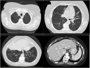 Thoracic CT scan showing emphysema in upper lobes and bronchiectasis in both inferior lobes. No abnormal findings were identified on abdominal CT scan: liver has standard size and regular edges.