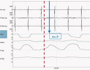 A tracing of a EMG recording of the diaphragm and intercostal muscles combined with a pressure tracing derived from an external pneumotachograph. At the place of the arrow diaphragm activity is observed without a pressure wave, so an ineffective effort occurs.