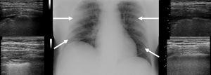 Chest X-ray on admission shows diffuse interstitial abnormalities alongside scattered bilateral infiltrates. Arrows indicate the local ultrasound patterns, in particular: irregular vertical artifacts (B-lines) with impaired pleural sliding next to subpleural small consolidations in the upper anterior sites and thick and confluent B lines in the low posterior site.