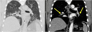 Computed Tomography Pulmonary Angiography (CTPA) described signs of Pulmonary Artery Thrombosis (PAT) involved the lower pulmonary branches (yellow arrows).