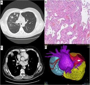 (A) CT of the chest revealed ground-glass opacities and patchy consolidations in the right upper and middle lobes. (B) Histologically, the transbronchial lung biopsy material revealed thickening of the alveolar septa with rare lymphocytes and accumulation of hemosiderin macrophages in the alveoli. (C) Chest angiography showed stenosis of the right superior pulmonary vein (arrow). (D) A 3-dimensional computed tomographic reconstruction demonstrated severe stenosis of the right superior pulmonary vein with subtotal occlusion (arrow).