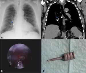 A - Posteroanterior chest radiography showed a right lower retrocardiac radiopaque foreign body (blue arrow). B - Chest computed tomography scan revealed a dental instrument foreign body in the distal portion of the intermediate bronchus, immediately prior to division into the right basal pyramid (blue arrow). C - Extraction of endobronchial metallic foreign body using by rigid bronchoscopy (Karl Storz® Universal Bronchoscope for Adults 10318BP, size 8,5 and Hopkins® Telescope 10320AA) using grasping forceps (Karl Storz® Forceps for Bronchoscopy 10370U), under general anesthesia with manual jet ventilation. D - The extracted foreign body was compatible with dental implant screwdriver.