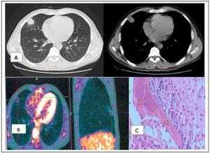A- Chest computed tomography with an irregular justa-pleural mass. In the anatomical piece, a white well-delimited area was observed and when sliced a yellow justa-pleural nodule with increased consistency measuring 2,3 × 1,9 × 1,2 cm was identified; B- PET-CT with low 18F-FDG uptake (1.3); C- The intraoperative histopathological diagnosis was granuloma without malignant cells. Postoperative histopathological diagnosis was consistent with a central zone of necrosis surrounded by granulomatous inflammation and a fibrous wall. A worm was found in the lumen of an artery within the area of necrosis containing remnants of Dirofilaria immitis.