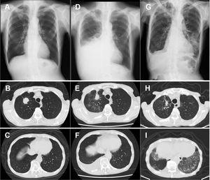 Chest X-ray (CXR) and computed tomography (CT) findings of an 86-year-old man on referral (A-C in March), relapse (D-F in August), and admission (G-I, in December). Both CXR and CT show bilateral ground-glass opacities on admission (G and I).