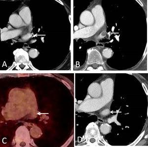 A, Axial contrast-enhanced CT image (mediastinal window), obtained 5 years after the left upper lobectomy, shows a patent left superior pulmonary vein stump (arrow). B, Axial contrast-enhanced CT image (mediastinal window), obtained 7 years after the left upper lobectomy, shows a filling defect within the left superior pulmonary vein stump (arrow). C, Axial fused PET/CT image (obtained 3 days after B) demonstrates lack of FDG uptake at the level of the left superior pulmonary vein stump (arrow), suggesting a non-tumor thrombus. D, Axial contrast-enhanced CT image (mediastinal window), obtained 3 months after B, shows resolution of the left superior pulmonary vein stump thrombus (arrow).