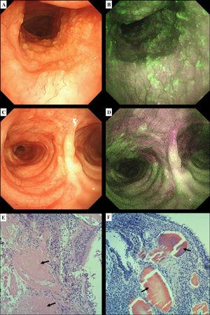 White light bronchoscopy (WLB) showing nodular mucosa irregularities along the anterior tracheal wall up to the carina (A); upon switching to autofluorescence imaging bronchoscopy, green spots interweaved with magenta areas are visible (B). Normal-appearing main carina on WLB (C); using autofluorescence imaging bronchoscopy, a flat pathological magenta lesion is now visible near the posterior tracheal wall (D). Tracheal biopsy showing abundant amorphous amyloid deposits within the submucosal tissue on standard haematoxylin-eosin staining (E, black arrows). Congo red staining demonstrates the characteristic orange-red appearance of amyloid deposits (F, black arrows).