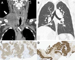 Cervical (A) CT scan revealed a voluminous heterogeneous right laterocervical mass, involving the ipsilateral internal jugular vein (white arrows). Thoracic (B) CT scan revealing multiple mediastinal and hilar nodes (white arrowheads) with no pulmonary findings. Immunohistochemistry from biopsy of the right supraclavicular mass whose pathology result was compatible with a large cell neuroendocrine carcinoma of the lung: positivity for neuroendocrine markers, including synaptophysin (C) and for thyroid transcription factor-1 (TTF-1) (D).