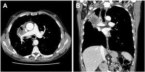 Contrast-enhanced axial (A) and coronal sectional (B) chest CT with mediastinal setting revealing a cavitary mass completely involving the middle lobe branch of the pulmonary artery causing stenosis in its proximal segment and distal ectasia.
