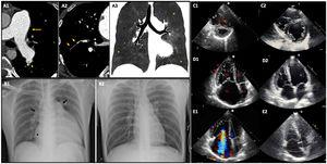 Imaging findings before and after combined treatment with pulmonary vasodilator therapy and balloon pulmonary angioplasty. Capture A: Vascular and pulmonary findings of chronic thromboembolism on CT pulmonary angiography. (A1) and (A2) Axial plane images reveal main pulmonary artery dilation (arrow), linear filling defects within pulmonary arterial vessels – webs (arrowhead), caused by residual thrombotic material, and bronchial arteries dilation followed by abrupt transition of size, irregularity and stenosis of multiple peripheral arteries (short arrows). (A3) Mosaic perfusion pattern (MinIP reconstruction image, coronal plane) defined by variable lung attenuation and due to heterogeneity of lung parenchyma, in which hypoperfused peripheral regions have low attenuation (*) compared to those of normal lung perfusion. Capture B: Comparison of chest X-ray before and after treatment (B1 and B2, respectively). (B1) Severe cardiomegaly, dilation of the right atrium (*), dilation of the main pulmonary artery and right pulmonary enlargement (arrows). (B2) Almost normal chest x-ray after treatment. Captures C to E: Comparison of transthoracic echocardiogram images before and after treatment (C1-E1 and C2-E2, respectively). (C1) End-diastolic short-axis view showing severe right ventricle (RV) dilation and interventricular septum deviation to the left caused by RV pressure overload (interventricular septal D-shape – short arrows), significantly impairing left ventricle diastolic filling. (D1) and E1) Apical four-chamber end-diastolic view (D) and Doppler mid-systolic image (E) showing initial dilated and hypertrophied RV (arrowheads), severely dilated right atrium (RA), associated with severe tricuspid regurgitation with an estimated PSAP of 88 mmHg. After treatment there was a significant decrease in right chambers’ size with only mild tricuspid regurgitation and improvement of LV diastolic filling.