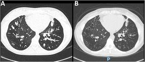 Chest CT scan of a 22-year-old female with CF (F508del/F508del genotype). (A) At baseline, diffuse bronchial thickening, intrabronchial mucus plugging, and bilateral bronchiectasis in lower lobes were evidenced. (B) After 6 months of ETI therapy, there was a significant reduction in mucus plugging and bronchial thickening.