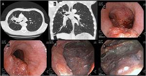 (A, B) Chest CT (A-axial; B-coronal): centrilobular emphysema and right cavitated hilar mass (79×39 mm) associated with irregularity in the calibre of the right main bronchus (RMB) and main carina. (C, D) Flexible bronchoscopy: Infiltrative lesion at the entrance of the RMB extending into the posterior wall of the main carina and upper third of the left main bronchus. (E) Lung parenchyma view at the entrance of RMB - RMB fistula with approximately 2 cm in diameter. (F) Distal view at the RMB.