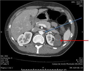 Angio-CT scan showing thrombosis ofthe left renal artery (blue arrow) and left kidney infarct (red arrow) at the time of diagnosis.