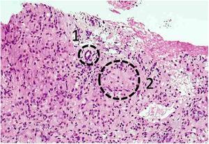 Liver biopsy showing moderate-to-severe interface hepatitis with portal inflammation (1) and emperipolesis (2).