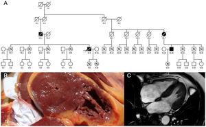 A)árbol genealógico del caso7 (IV.9) con hallazgos de MCH en autopsia (B). El estudio familiar detectó otro varón con MCH (IV.20). C)cardiorresonancia magnética del paciente IV.20 en la que se observa hipertrofia simétrica con grosor máximo de 16mm. MCH: miocardiopatía hipertrófica; N: no afecto; cuadrado: varón; círculo: mujer; raya diagonal: fallecido; elemento sombreado: afecto.