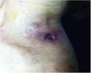 Úlcera no ombro esquerdo após biópsia.