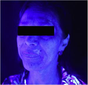 Vitiligo na face, em posição frontal (exame com luz de Wood).