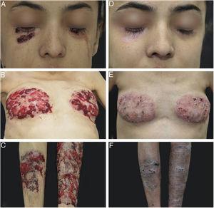 Lesões cutâneas antes (direita) e após (esquerda) seis meses de tratamento.