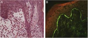 Penfigoide bolhoso. (A) Espongiose eosinofílica focal adjacente à área de clivagem subepidérmica (Hematoxilina & eosina, 400×). (B) Imunofluorescência direta com depósito linear de IgG na zona da membrana basal.