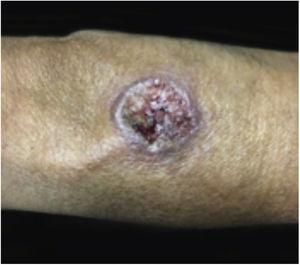 Lesões de leishmaniose cutânea podem se assemelhar às lesões clássicas de PG.