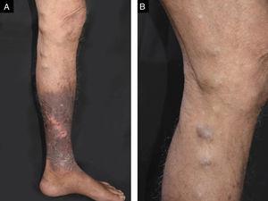Presença de úlceras com infiltração perilesional, eritema e descamação na perna esquerda (A); lesões nodulares, endurecidas, acastanhadas e em cordão foram também observadas na parte medial da perna esquerda (B).