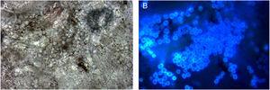 Microscopia com cálcio fluorescente das escamas evidencia numerosos esporos (luz original [A] e luz fluorescente [B] no mesmo campo, 1000×).