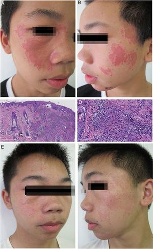 (A) Apresentação clínica na primeira consulta. Múltiplas placas eritematosas bem definidas comprometem a face. (B) Lesões deprimidas com “borda em penhasco”. (C) Padrão de reação granulomatosa caracterizado por múltiplos granulomas na derme superior (Hematoxilina & eosina, 50×). (D) Granulomas de células epitelioides, sem necrose central e com um infiltrado linfocítico esparso (Hematoxilina & eosina, 200×). (E) Apresentação clínica no fim do tratamento evidencia o desaparecimento da maioria das lesões cutâneas. (F) Áreas avermelhadas residuais.