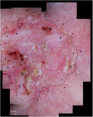 Imagem de DDAA de CBC. Achados dermatoscópicos nas margens que consistem de ulceração e crostas (Δ), áreas branco‐cicatriciais (◊) e telangectasias arboriformes (†), em contrate com as telangectasias da pele fotodanificada periférica.